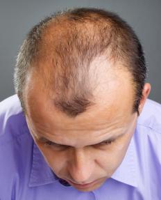 A man with thinning hair.