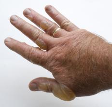 A man with rhus dermatitis from a poison ivy plant.