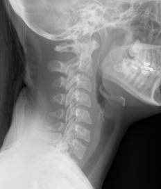 An X-ray of the neck, including the cervical vertebrae.