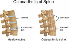 A picture of a healthy spine and one with bone spurs.