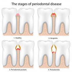 The stages of periodontal disease, including periodontitis.