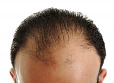 A man with a receding hairline.
