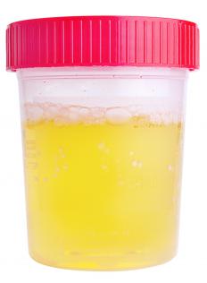 A urine sample for a urine organic acids test.