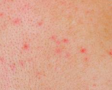 A stress rash.