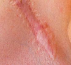 Scar tissue