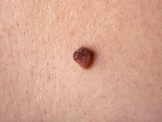 A benign mole