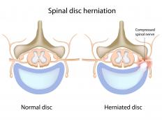 A healthy spine and a spine with a bulging disc.