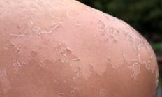 Using hydrocortisone may increase a person's risk of sunburn.