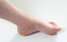 A person with a sprained foot.