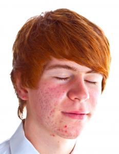 A boy with acne