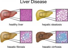 Several types of liver disease, including hepatic steatosis (fatty liver). When the liver is also inflamed, it's called steatohepatitis.