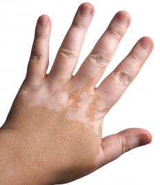 A person's hand with an uneven distribution of melanin.
