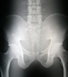 An X-ray of the pelvis, showing the sacroiliac joint.