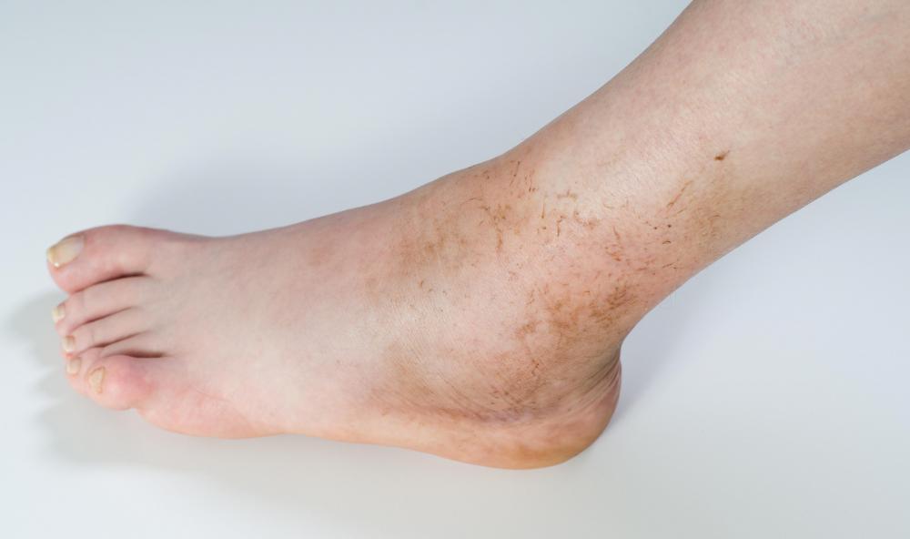 Red patches on sole of foot - HealthcareMagic