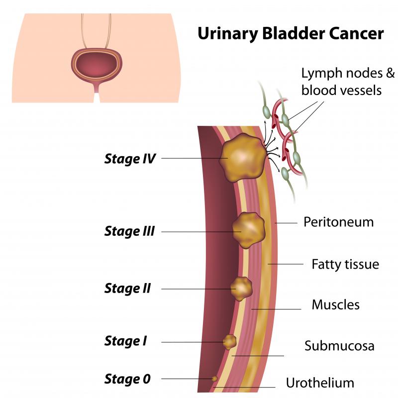 What is a biopsy?