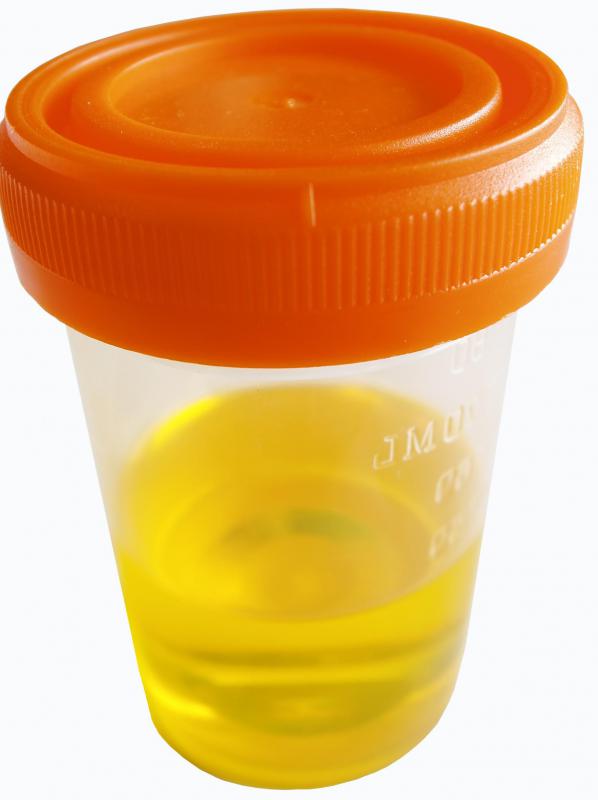 A urine sample may be performed in addition to a urethral swab.
