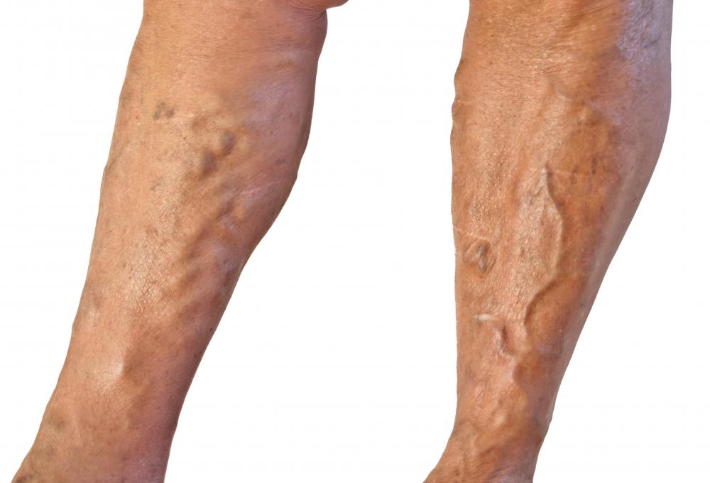 What is deep vein thrombosis?