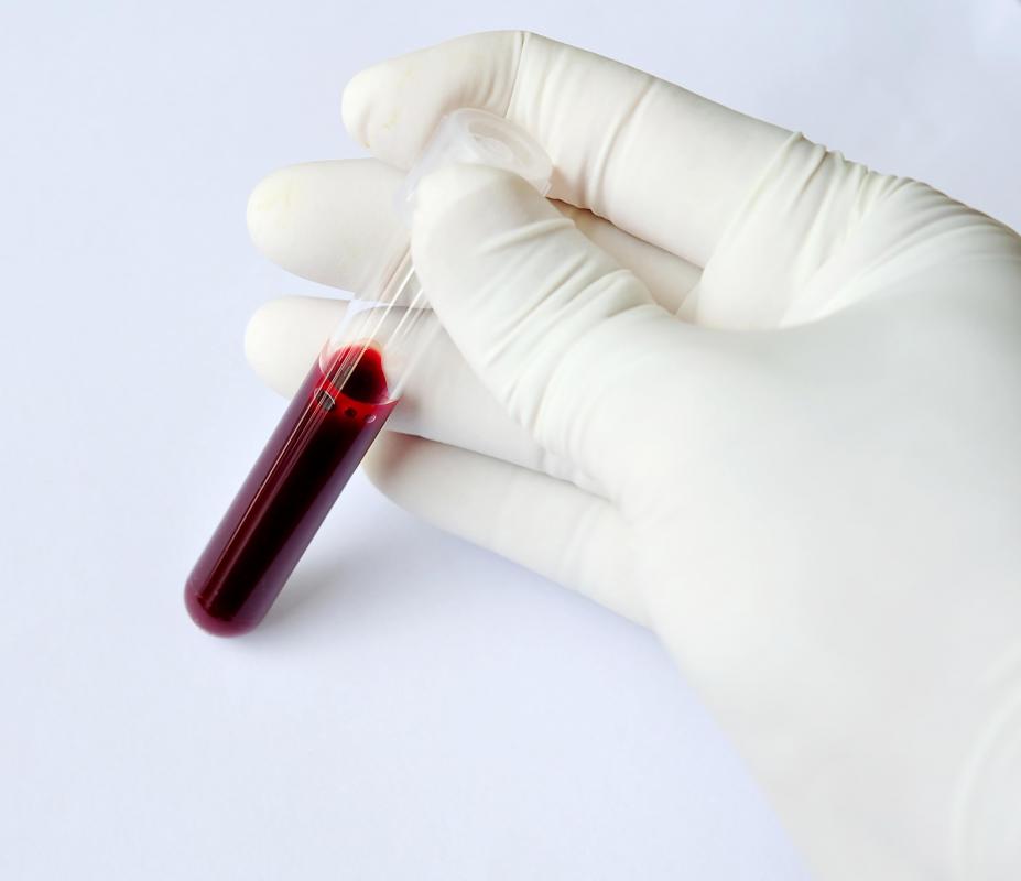 Blood tests will need to be conducted in order to diagnose Conn's syndrome.