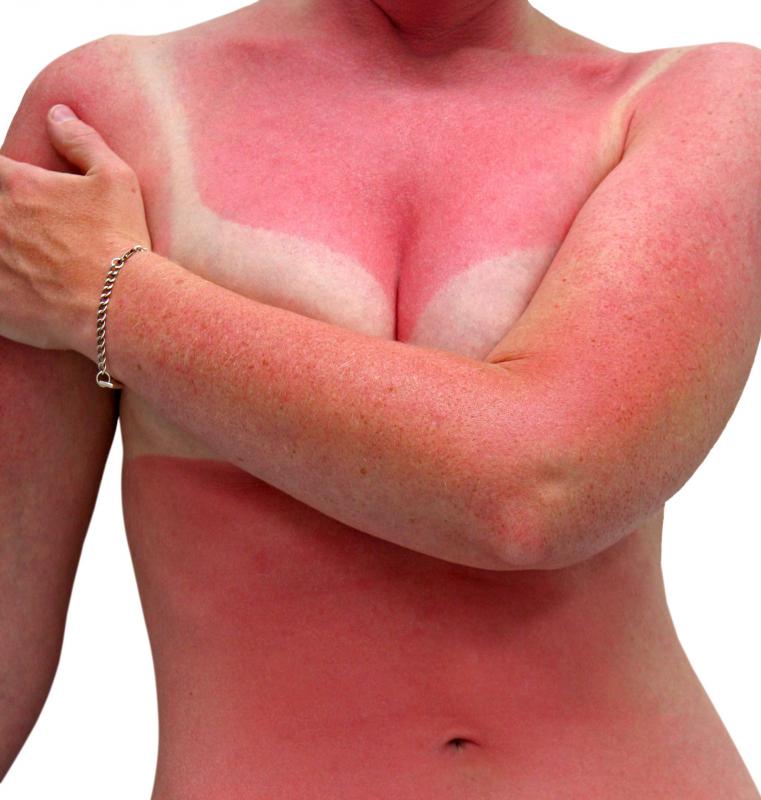 What is the best way to deal with sunburns?