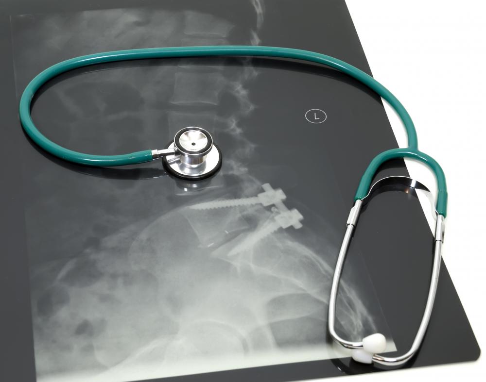 A type III separated shoulder can be fixed using surgery to insert screws to keep the AC joint together.