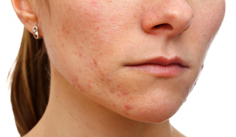 How do I Use Chinese Medicine for Acne with pictures 