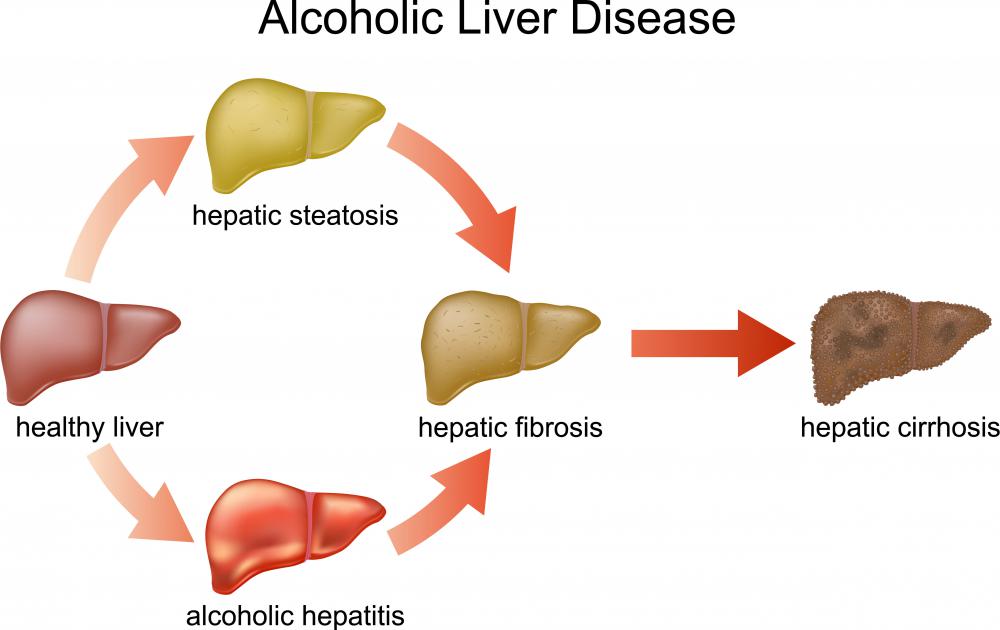 How Effective Is Rifaximin for Hepatic Encephalopathy?