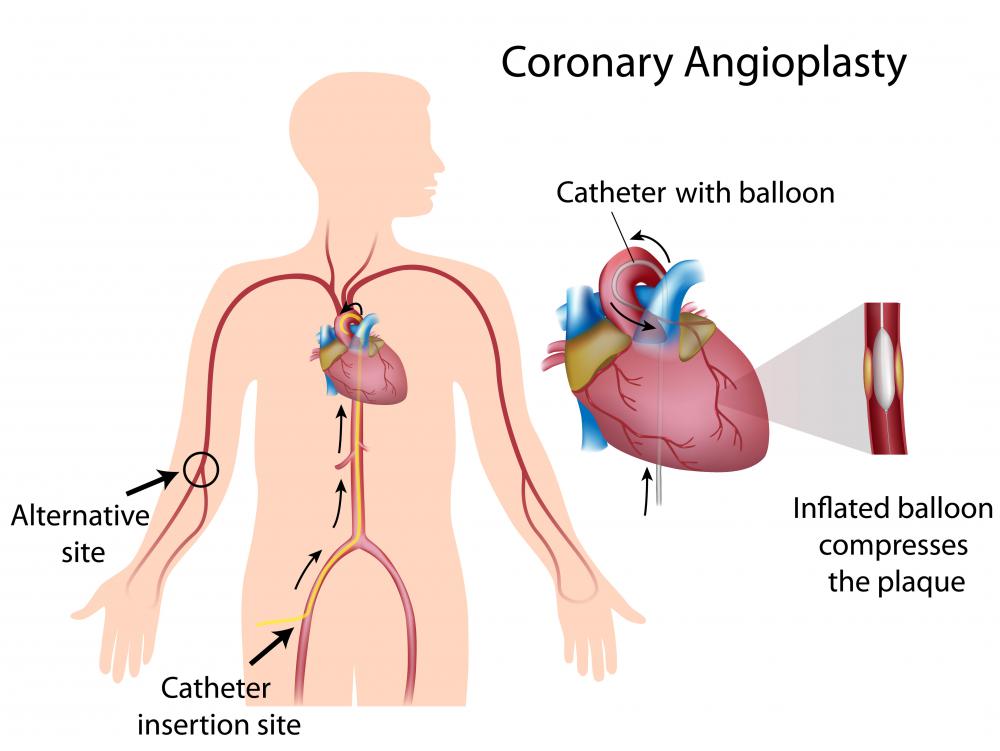 what-is-angioplasty-with-pictures