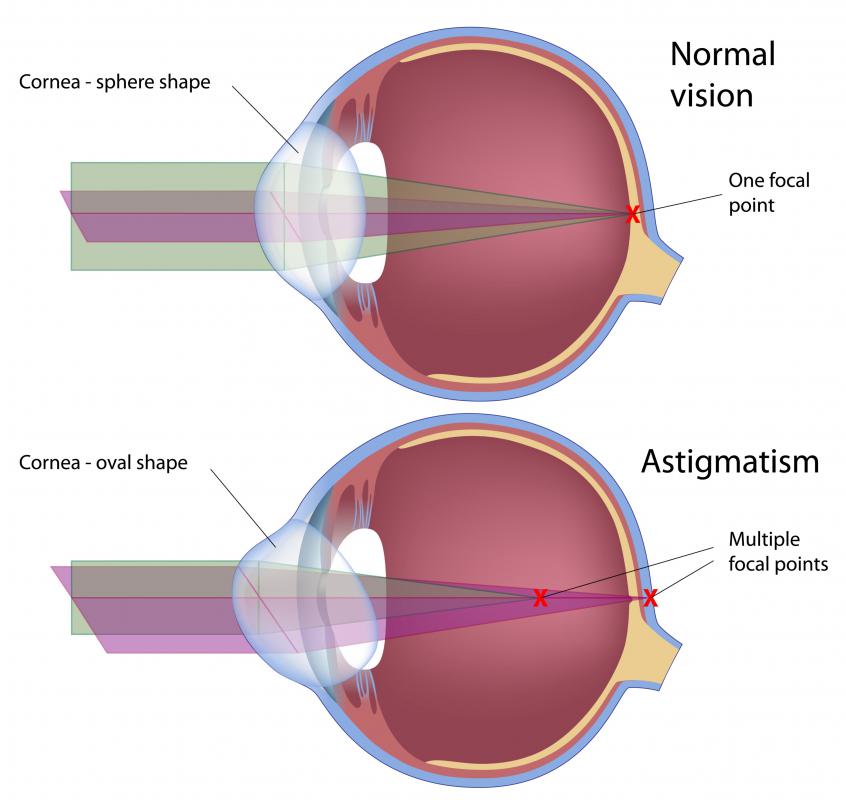 vision loss normal lens normal retina