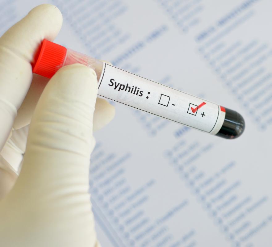 Syphilis Test Results