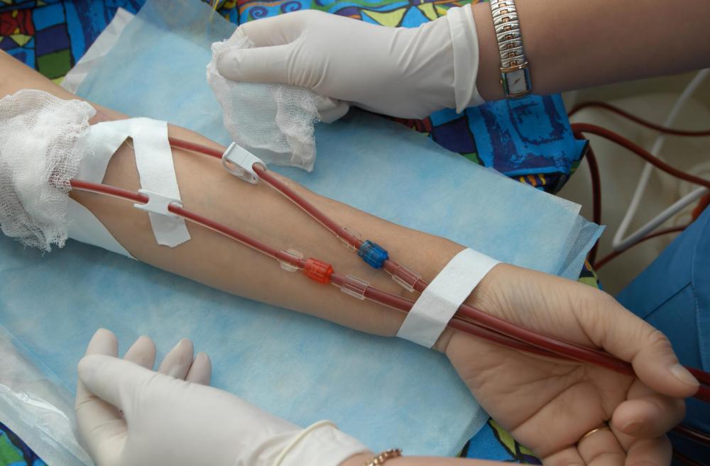 What is an Exchange Transfusion? (with pictures)