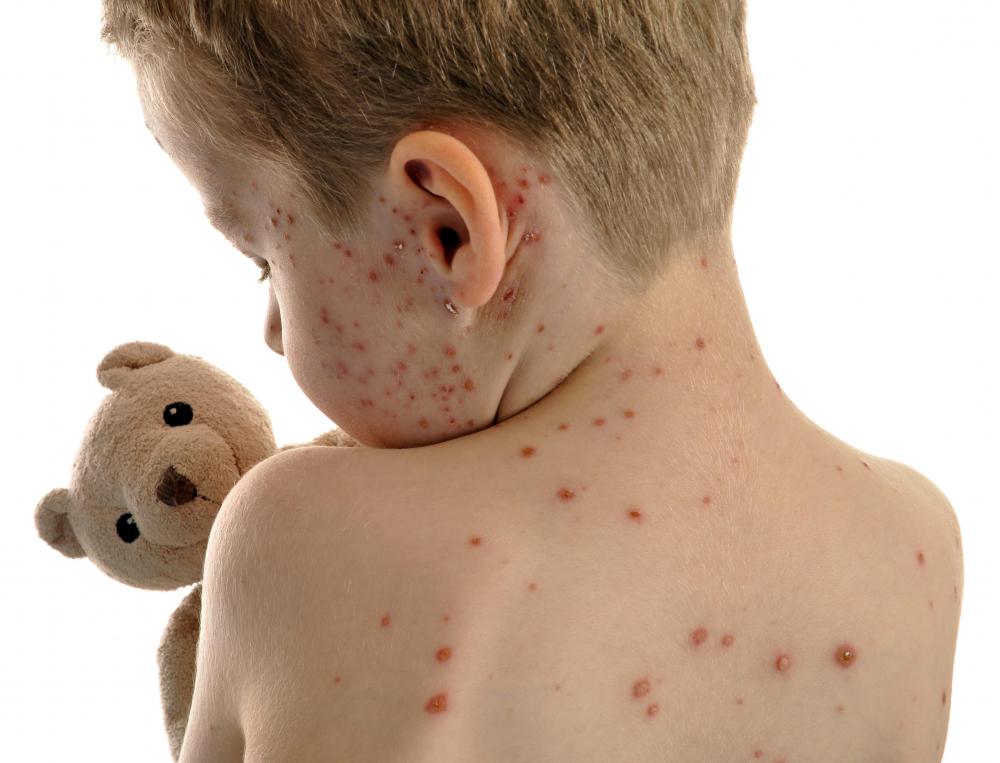 How Do I Tell The Difference Between Measles And Chickenpox