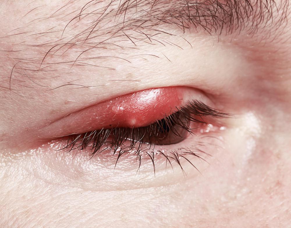 stye eye infection symptoms styes eyelid different remedies manage burst blinking redness produces pain