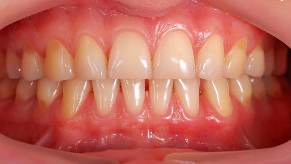 What Is Gingival Tissue? (with pictures)