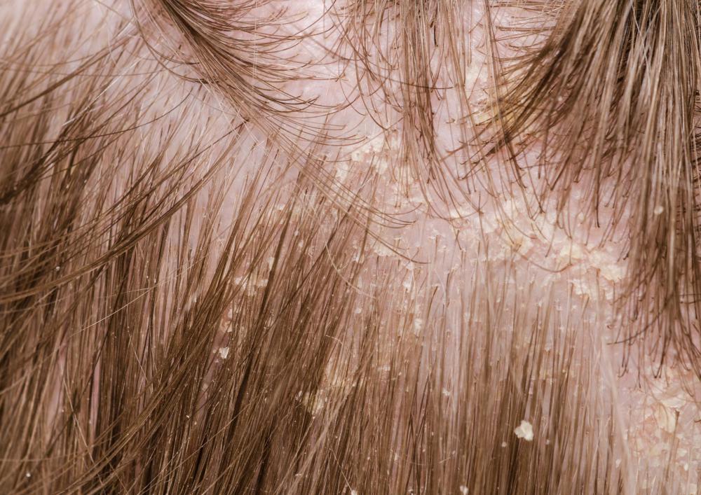 How To Get Rid Of Dead Skin Flakes On Scalp