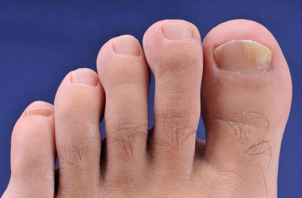 White Residue Between Toes