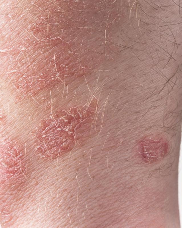 what-is-guttate-psoriasis-with-pictures