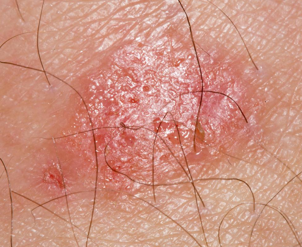 what-are-the-most-common-causes-of-leg-rashes-with-pictures