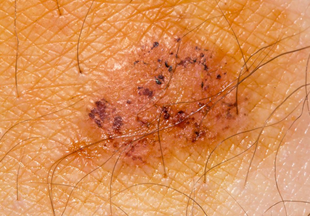 Clotrimazole Used For Ringworm