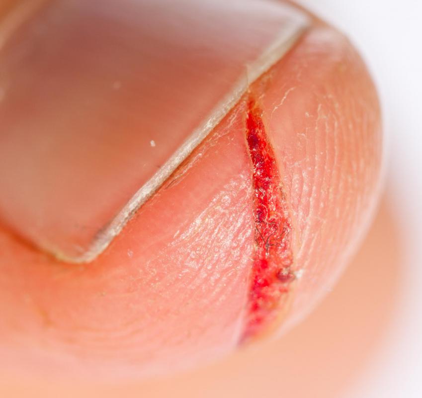 What Are The Symptoms Of A Finger Infection With Pictures