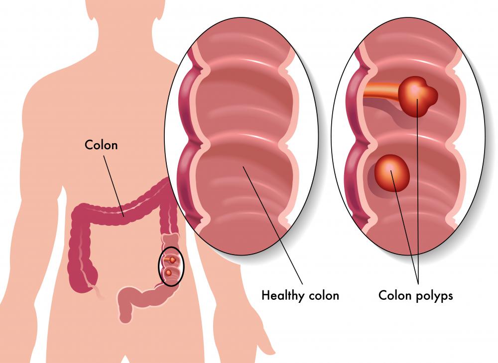 What Is A Rectal Polyp With Pictures 