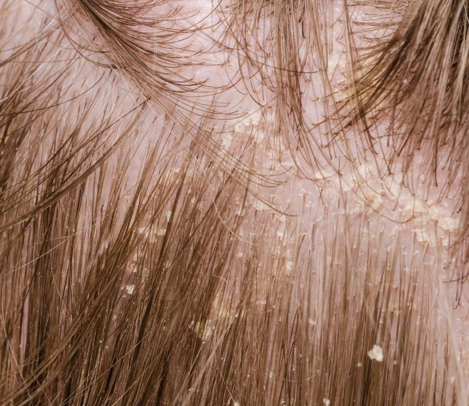 What Are The Different Types Of Scalp Conditions