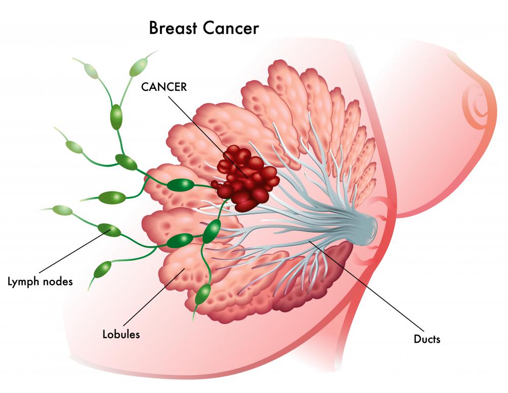 Breast Cancer A Serious Condition