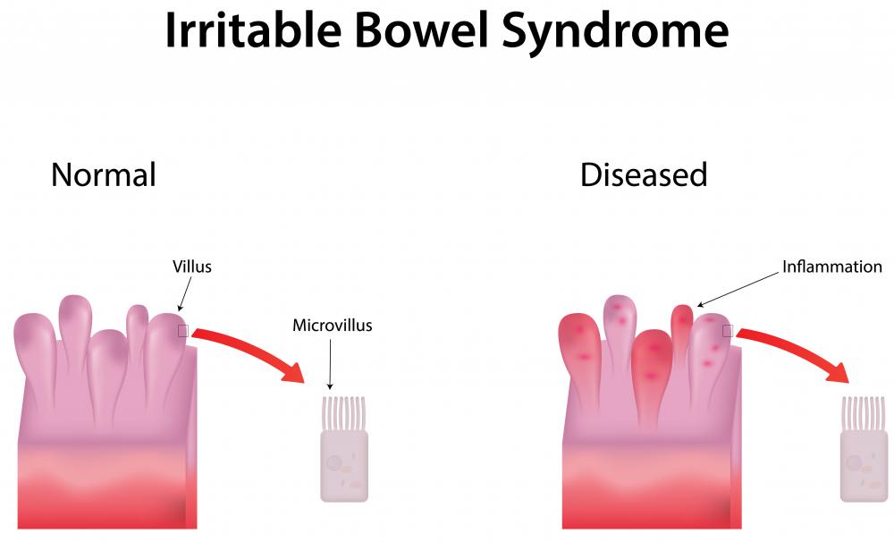 What Is Splenic Flexure Syndrome With Pictures 7918