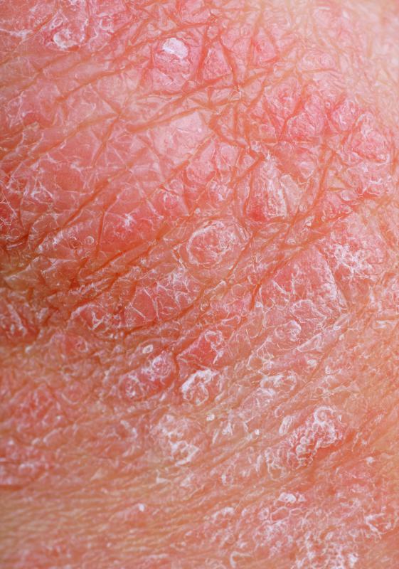 what-are-the-different-contact-dermatitis-treatments