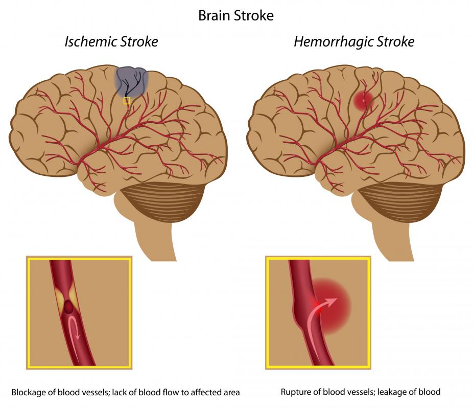 What Is The Difference Between An Ischemic Stroke And A Hemorrhagic Stroke