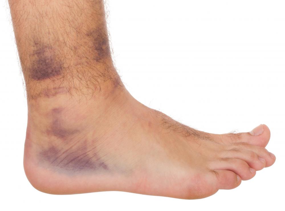 What are the Symptoms of a Blood Clot in the Foot?