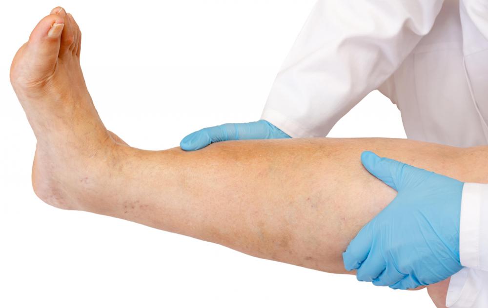 How To Treat Severe Leg Edema