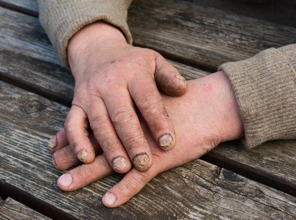 what-are-the-different-fingernail-fungus-treatments