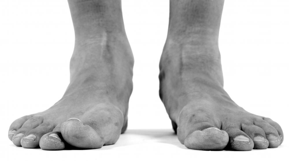 The severity of flat feet can determine whether someone will be allowed into the military.