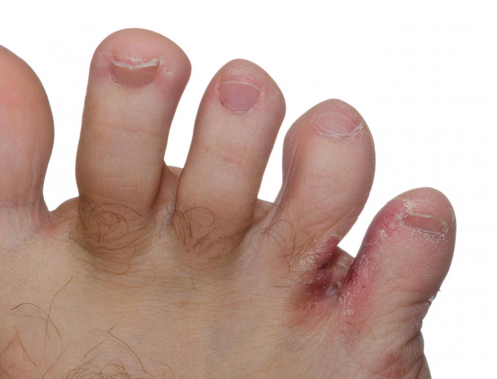 itchy cracked skin between toes